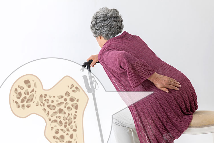 骨粗しょう症